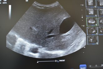 Leber und Gallenblase im Ultraschall
