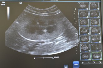 Niere bei der Ultraschaldiagnostik